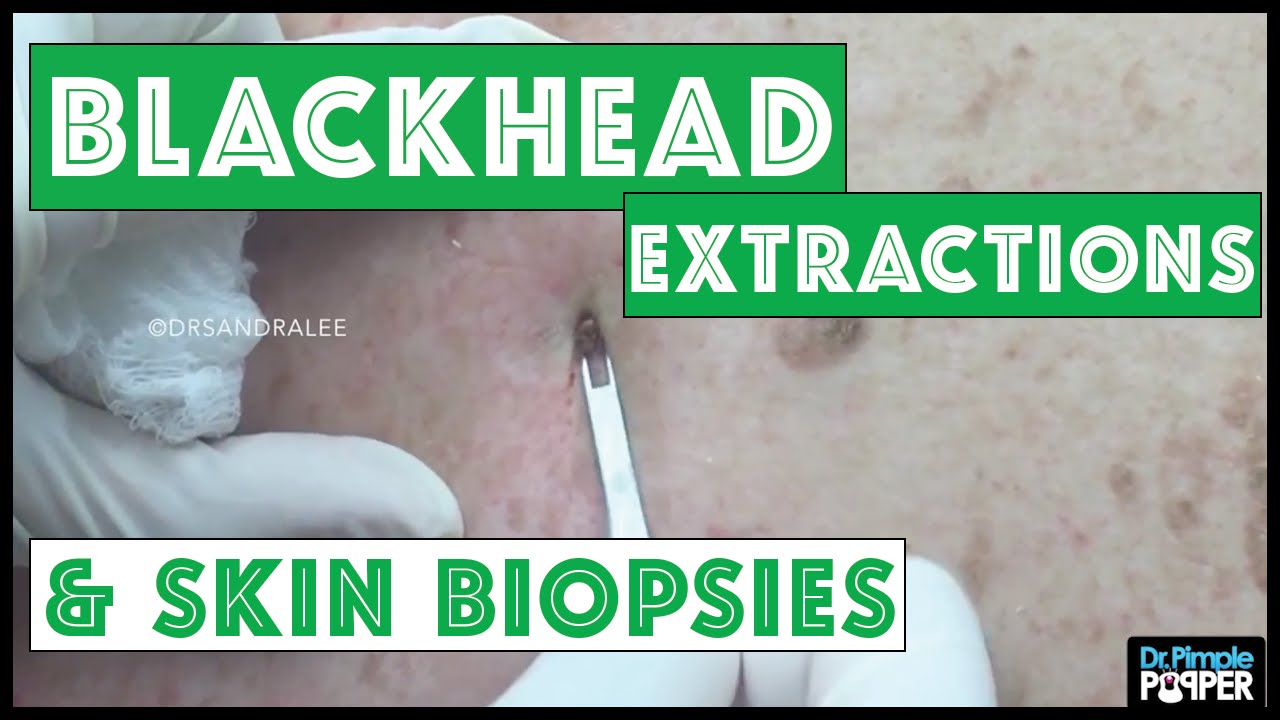 Blackhead extractions & 2 Skin Biopsies