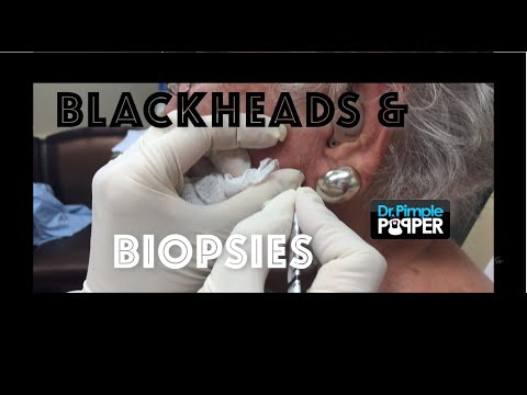 Blackhead extractions and skin biopsies