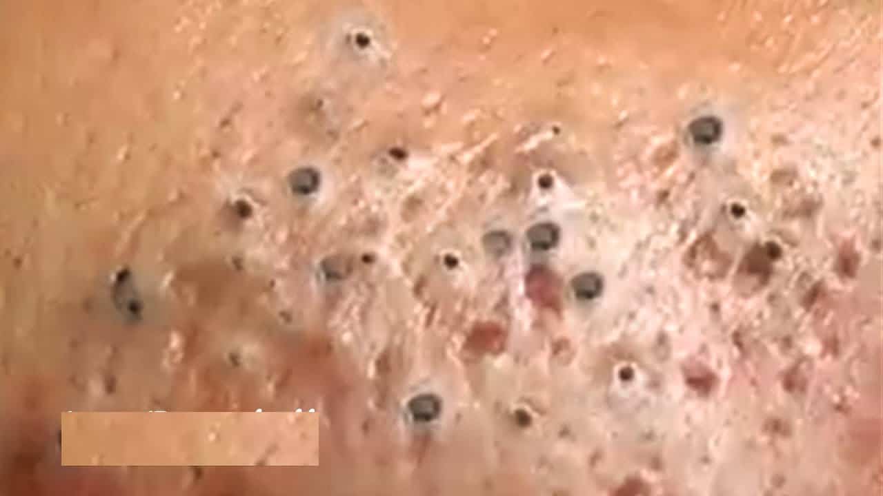 Blackhead Extractions | Blackheads Removal | Big Acne Treatment | Cystic Acne Extraction