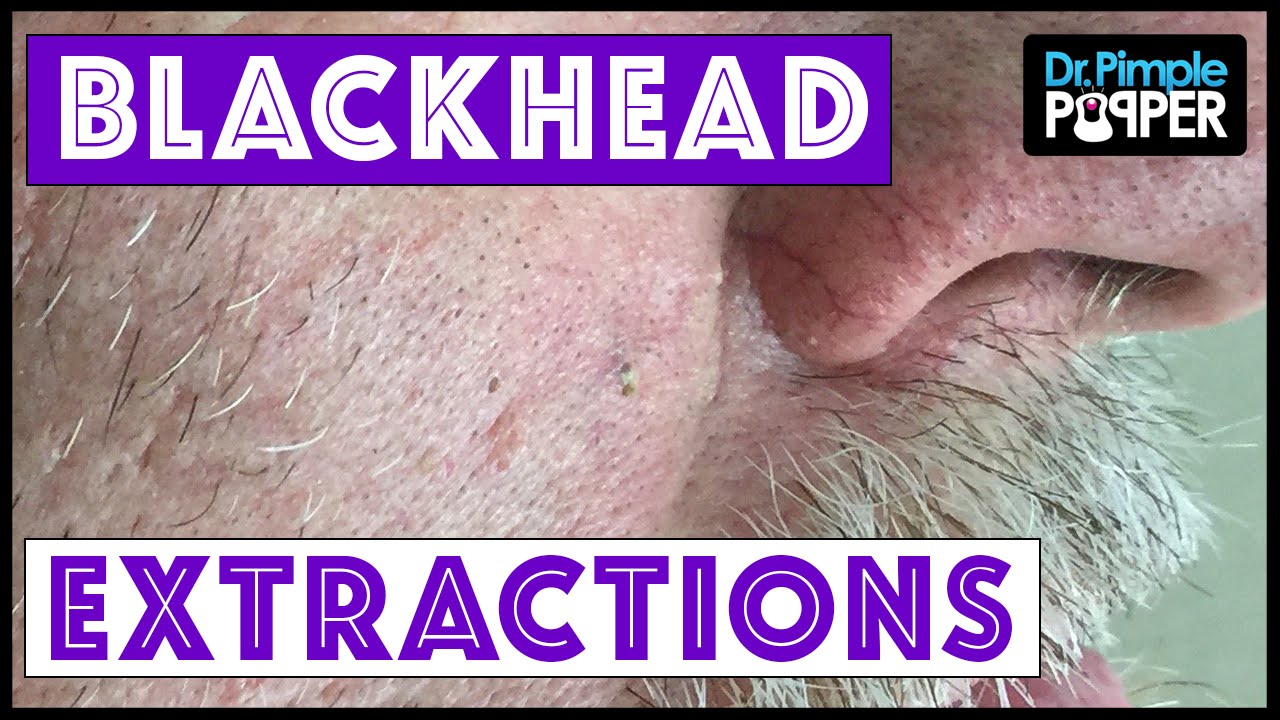 Blackhead Extractions for his lovely wife!