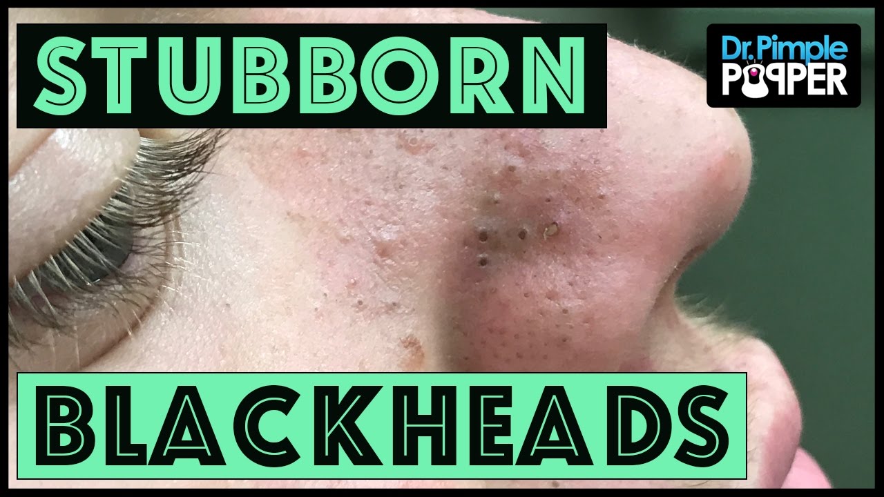 Blackhead Extractions in a Teenager with Acne