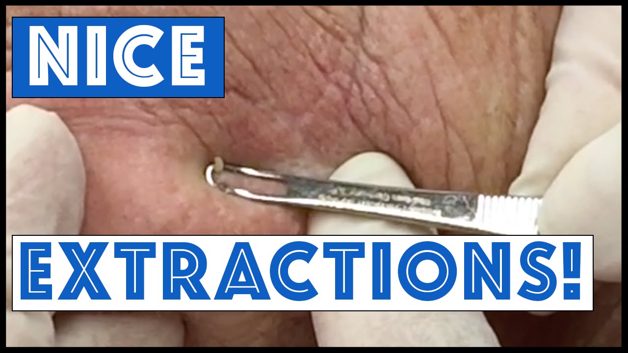 Blackhead Extractions in a Wonderful Patient !