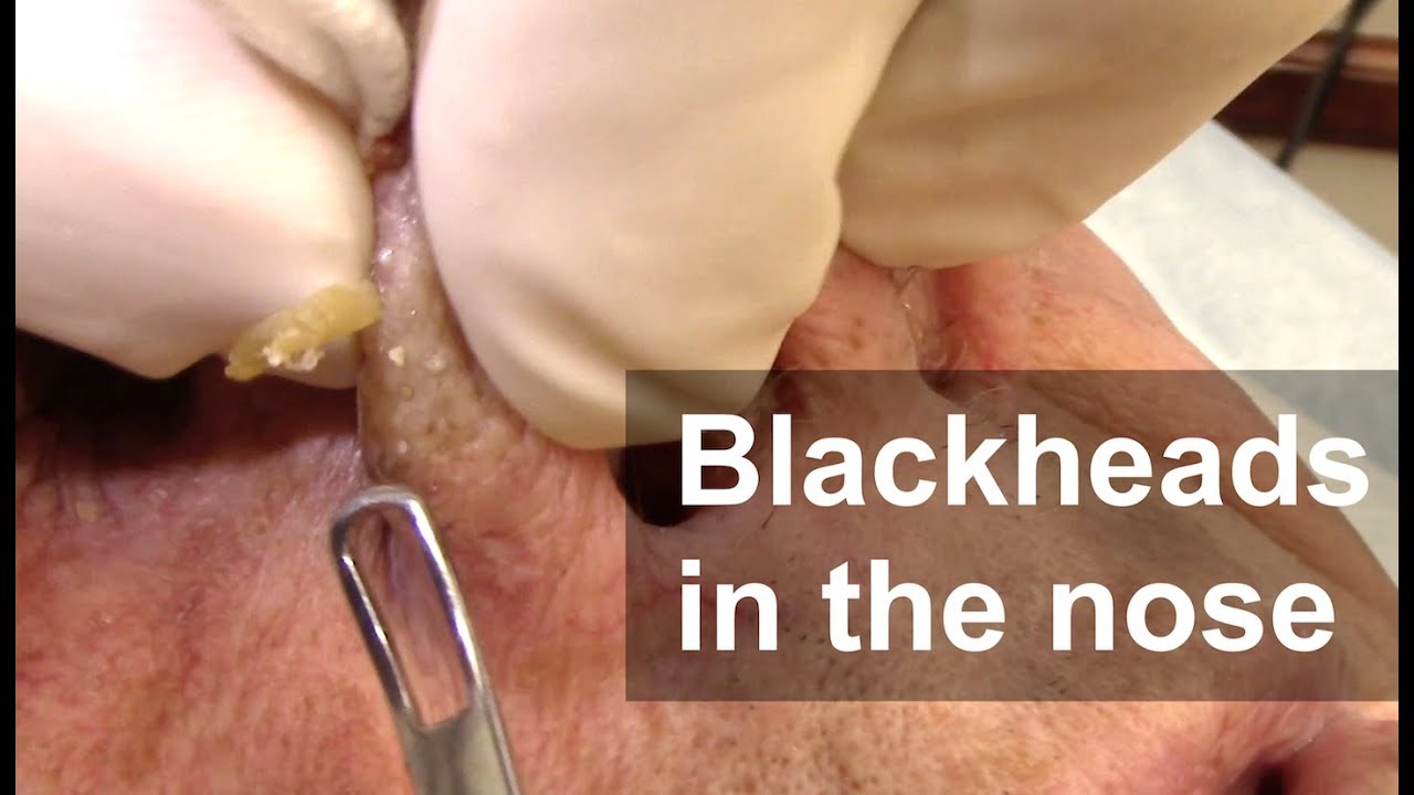 Blackhead Extractions on the Nose | Dr. Derm