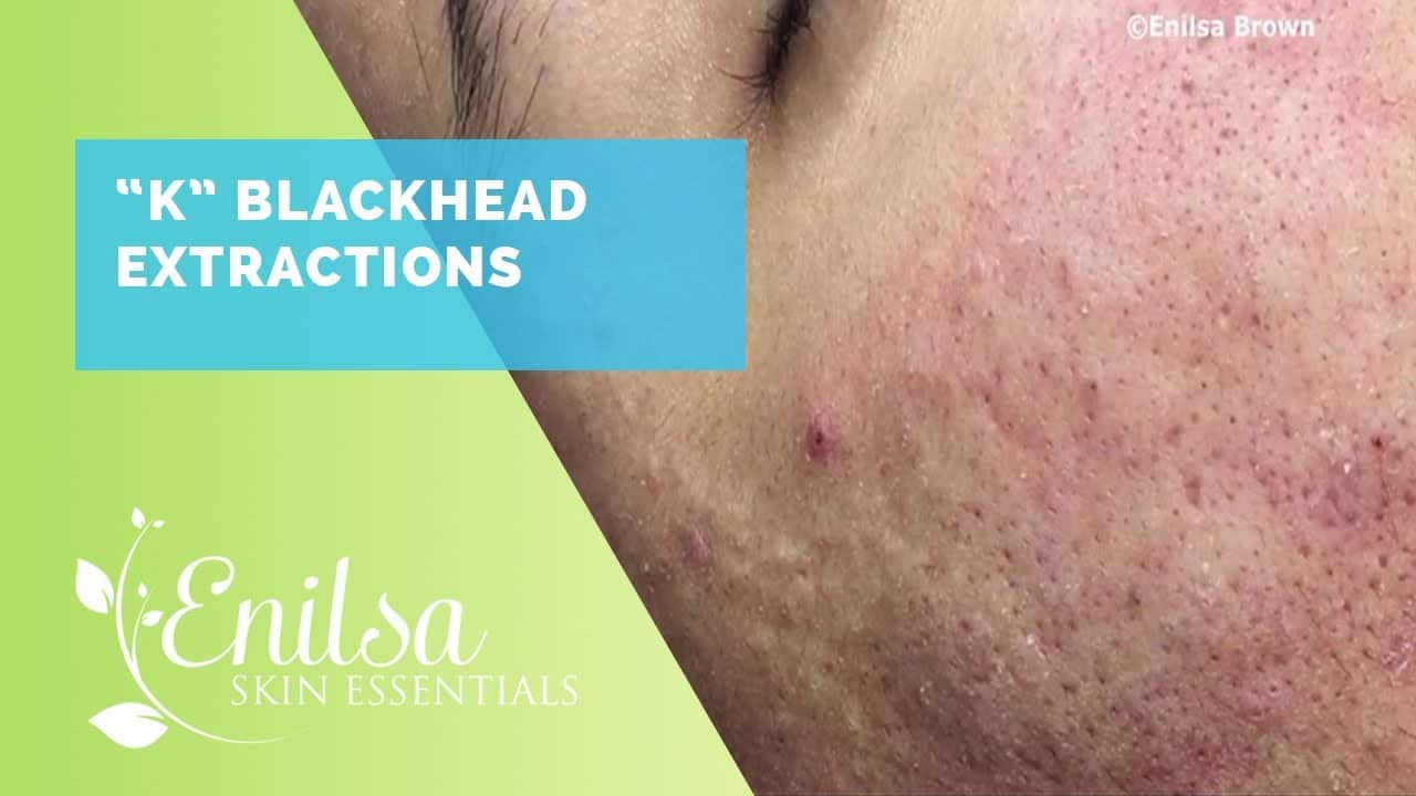 Blackhead Extractions Special “K” Another Great Video