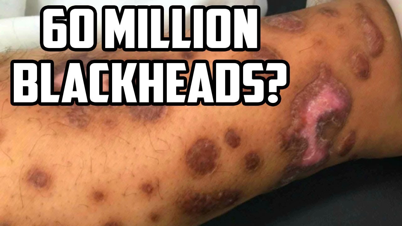 Blackhead Facts!  Acne, Dermatology & Pimple Popping Stats