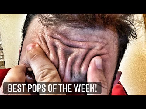 Blackhead King's Pimple Popping Week in Review!