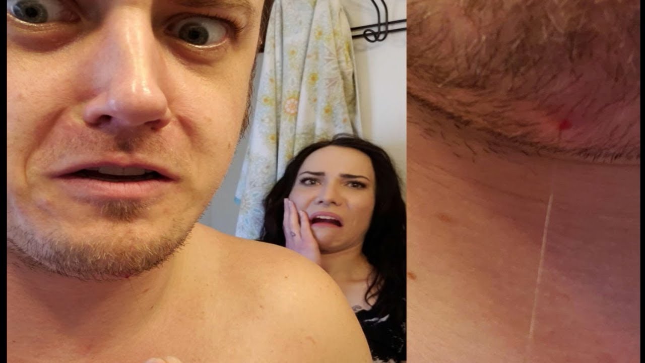Blackhead King's Pimple Popping Week in Review!  Cysts, Abscesses, Blackheads & Comedones