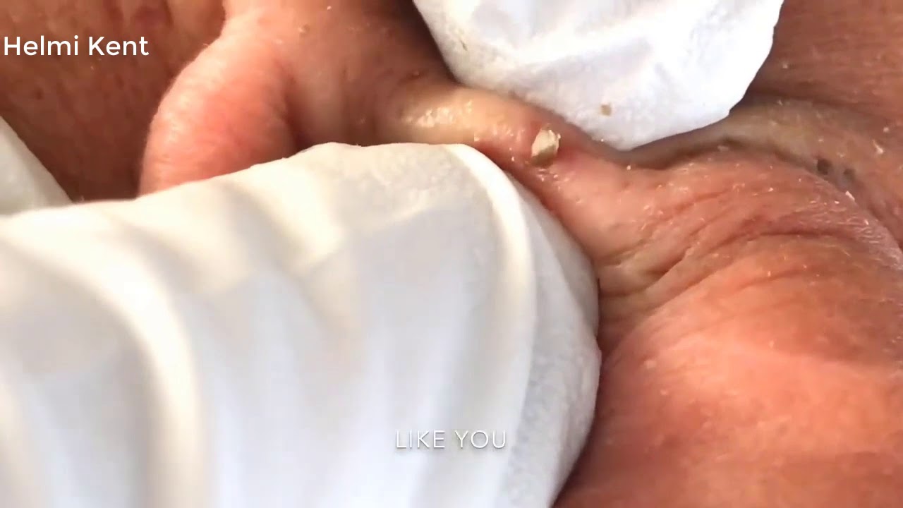 Blackhead Popping Video 2019 #1 | DrKent – Removal Pimple Popping Hd