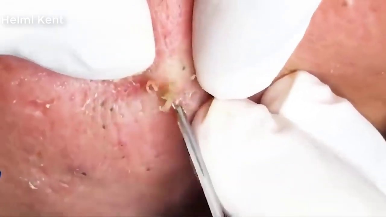 Blackhead Popping Video 2019 #2 | DrKent – Removal Pimple Popping Hd