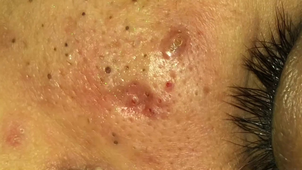 BLACKHEAD REMOVAL by POPPING KING DR.LALIT KASANA