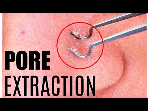 BLACKHEAD Removal + Extraction | How To POP a Pimple by Golani