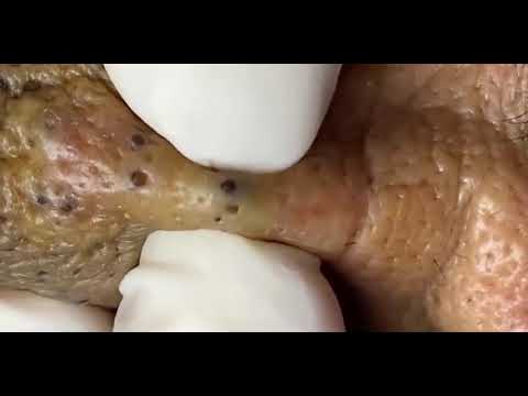 Blackhead removal from nose nose | Big blackhead | Satisfying