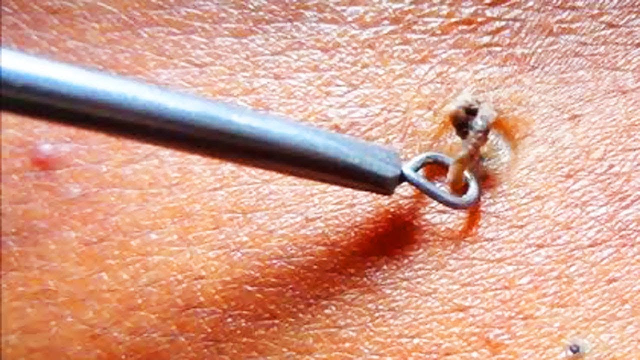 Blackhead Removal Tool in Action