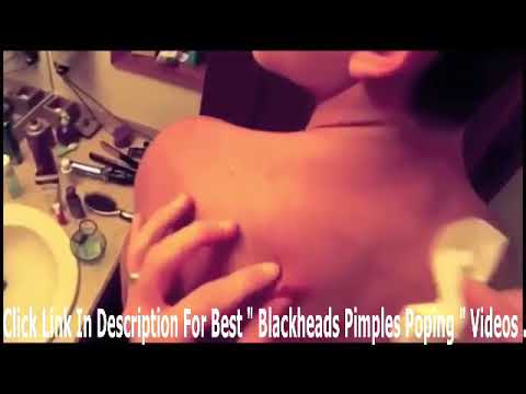 Blackhead removal treatment   cysts popping 2018  │video compilation 2018