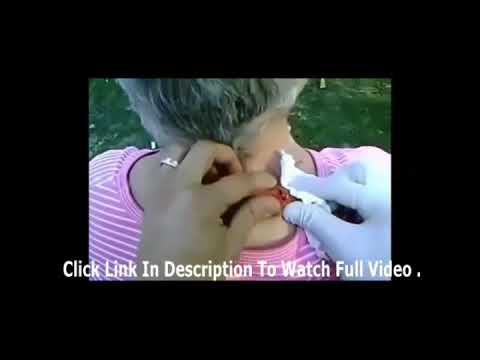 Blackhead removal treatment   cysts popping 2018  │video compilation 2018