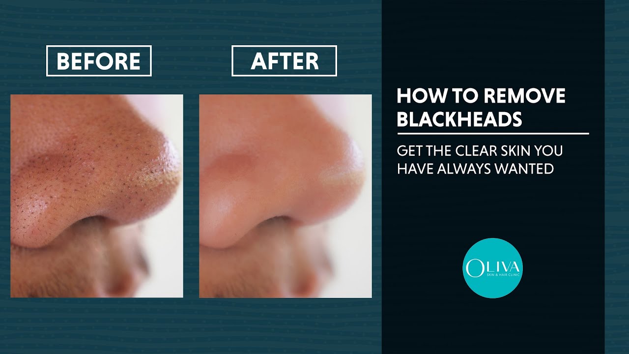 Blackhead Removal Treatments With Before And After Results