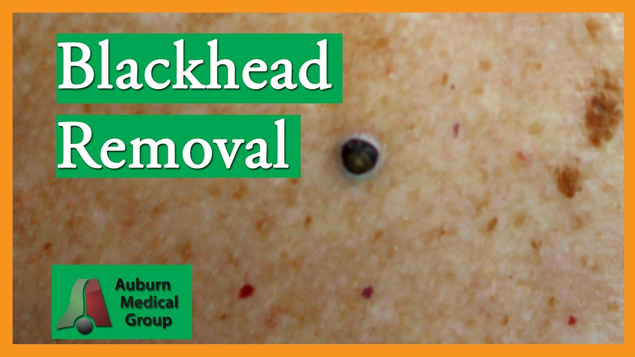 Blackhead Removal without Extractor Tool (Edited) | Auburn Medical Group