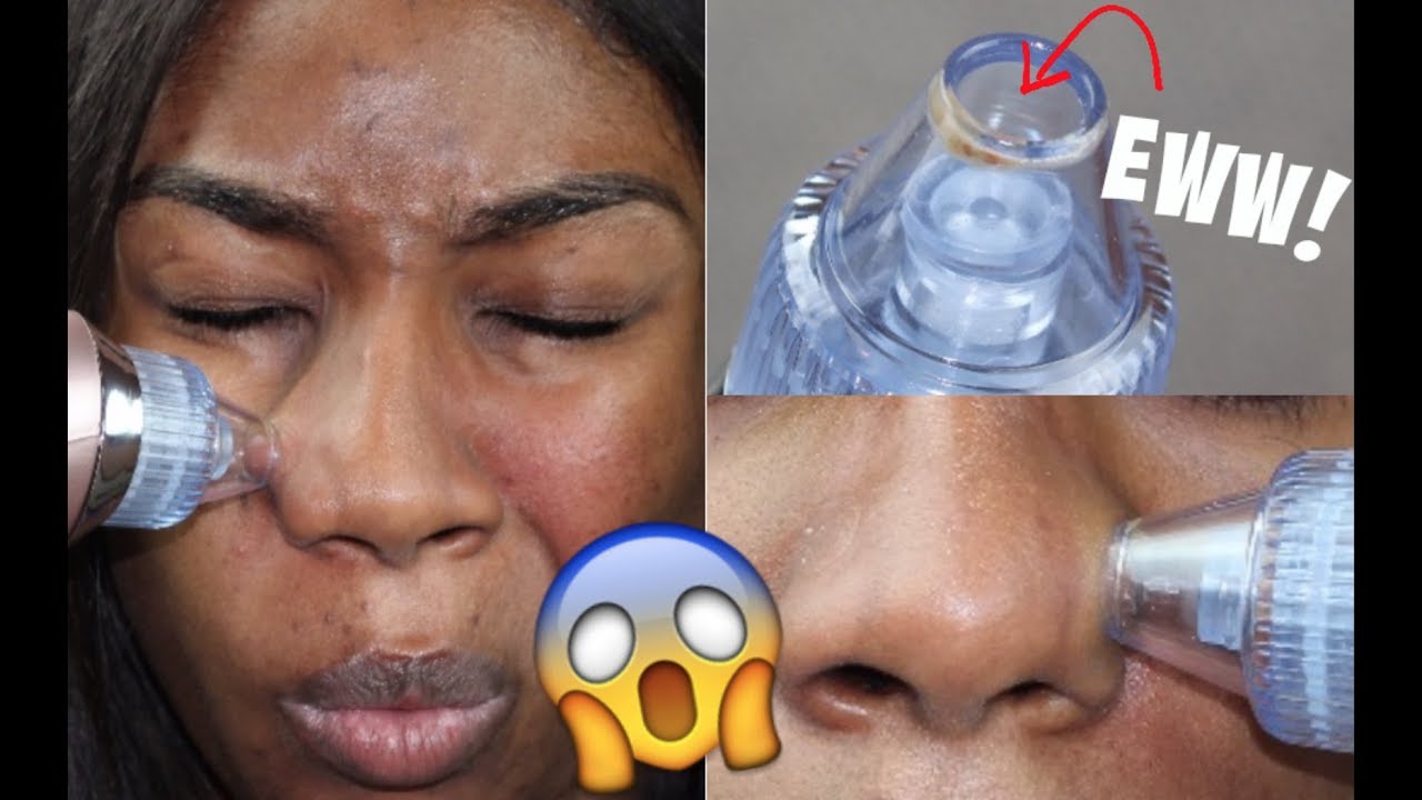 BLACKHEAD REMOVER VACUUM SUCTION | Does It Work?