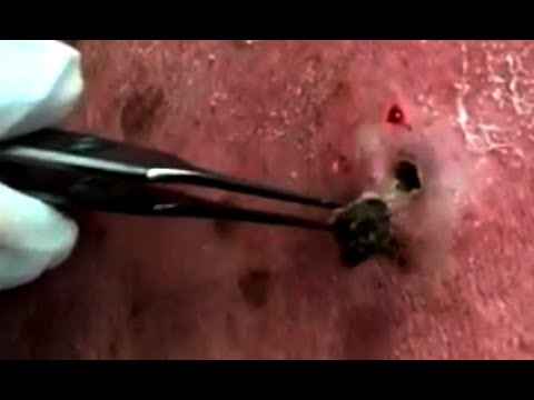 Blackhead Squeezed Pimple Removal