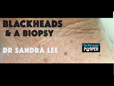 Blackhead & whitehead extractions and a skin biopsy