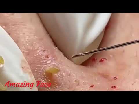 #blackheadpopping, #cystpop, #cysticacne, #pimples