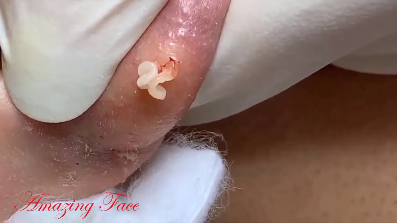 #blackheadpopping, #cystpop, #cysticacne, #pimples