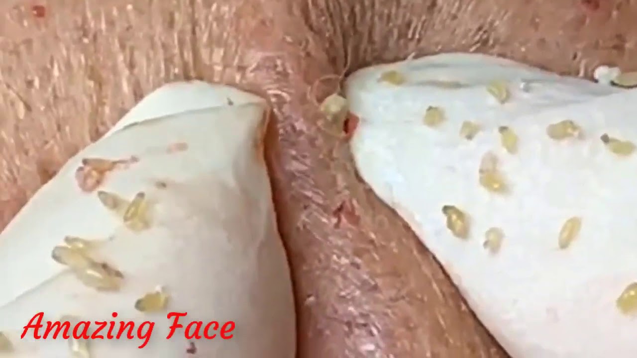 #blackheadpopping, #cystpop, #cysticacne, #pimples