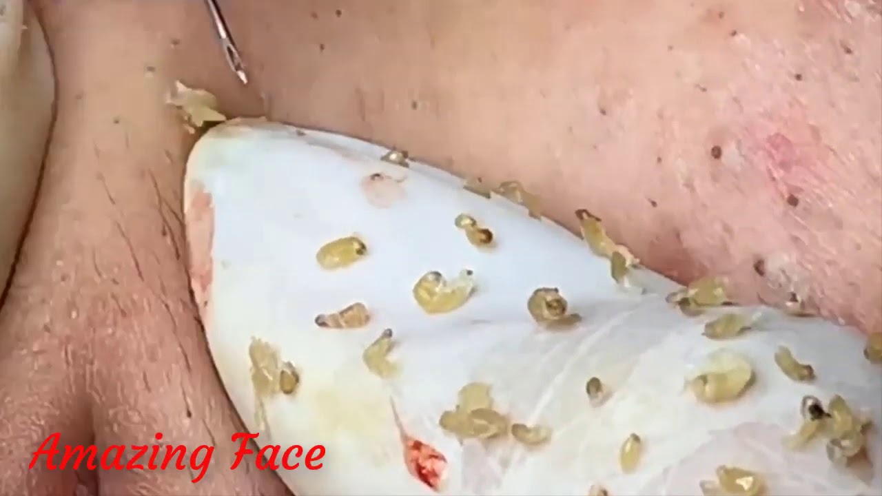 #blackheadpopping, #cystpop, #cysticacne, #pimples