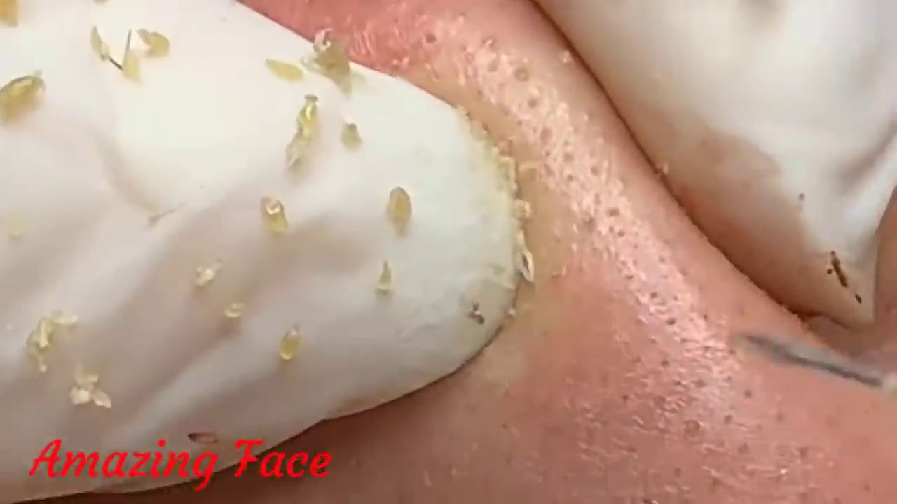 #blackheadpopping, #cystpop, #cysticacne, #pimples