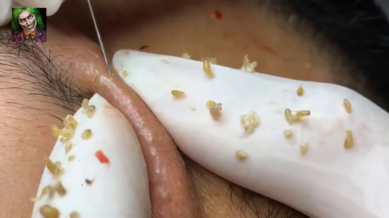 #blackheadpopping, #cystpop, #cysticacne, #pimples