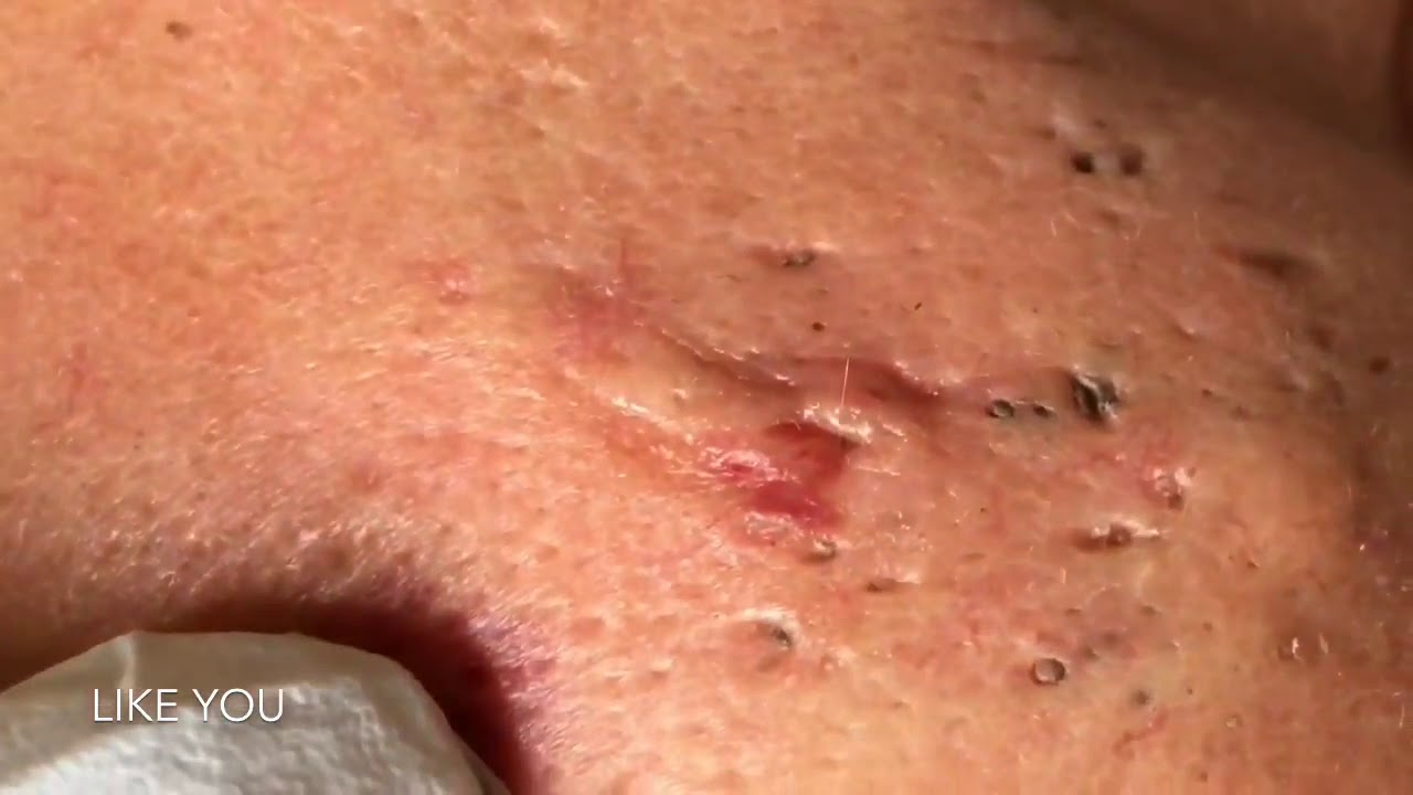 #BLACKHEADS#