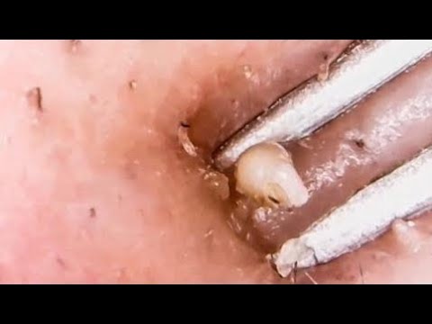 Blackheads 2018 | Blackhead Squeeze, Popping, Pimples Removal – Part 9