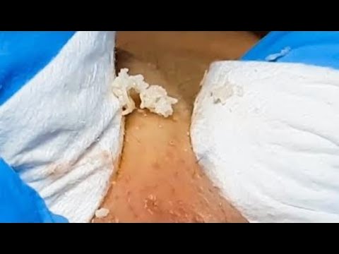 Blackheads 2018 | Blackhead Squeeze, Popping, Pimples Removal – Part 8