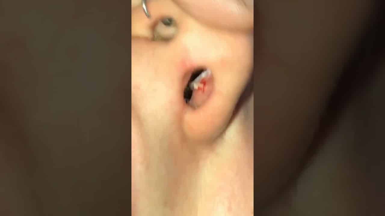 Blackheads 2021 newest dr pimple popping videos Ep 134