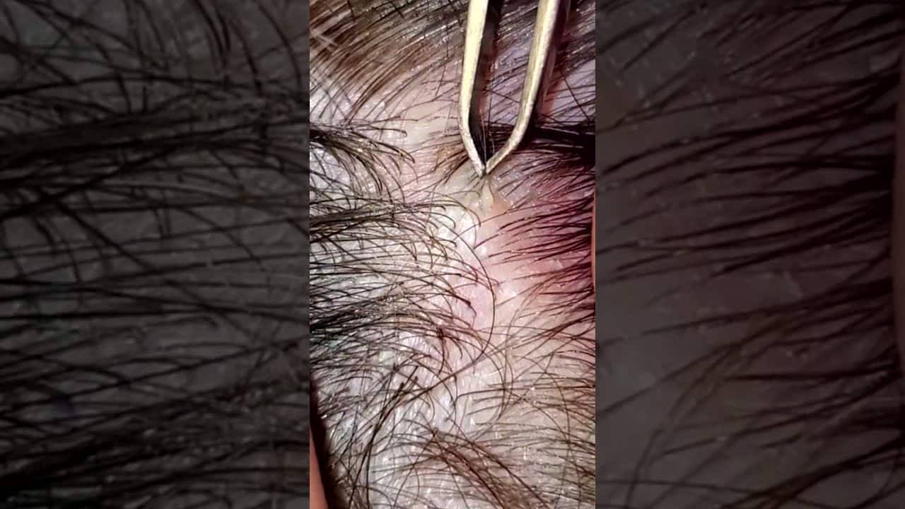 Blackheads 2021 newest dr pimple popping videos Ep 128