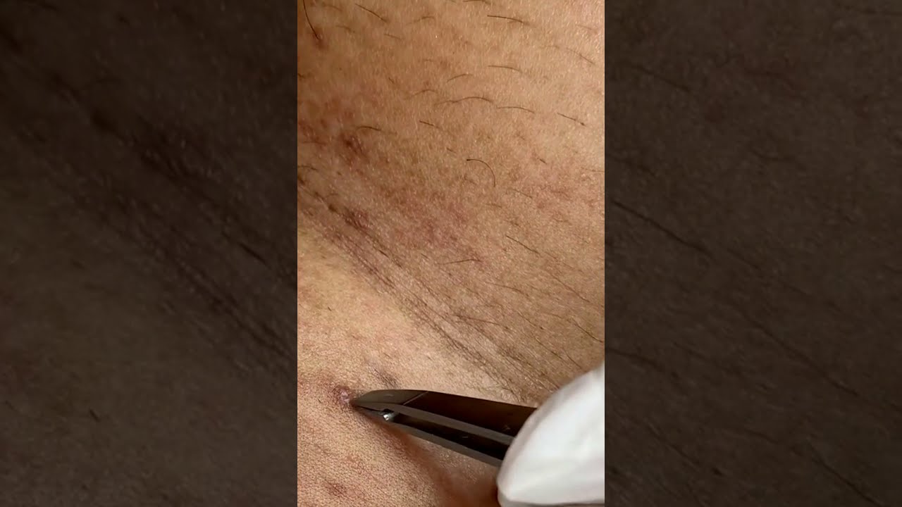 Blackheads 2021 newest dr pimple popping videos Ep 113