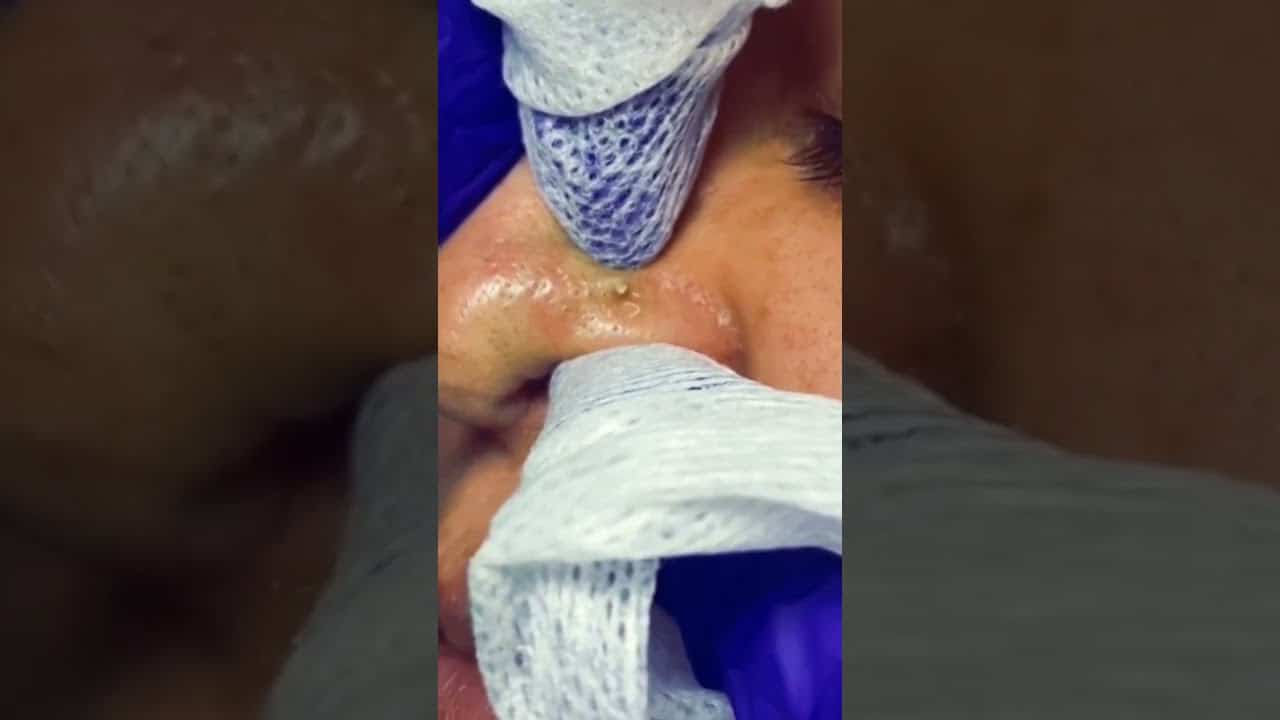 Blackheads 2021 newest dr pimple popping videos Ep 91