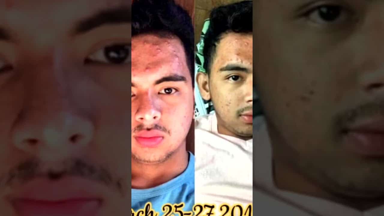 Blackheads 2021 newest dr pimple popping videos Ep 34