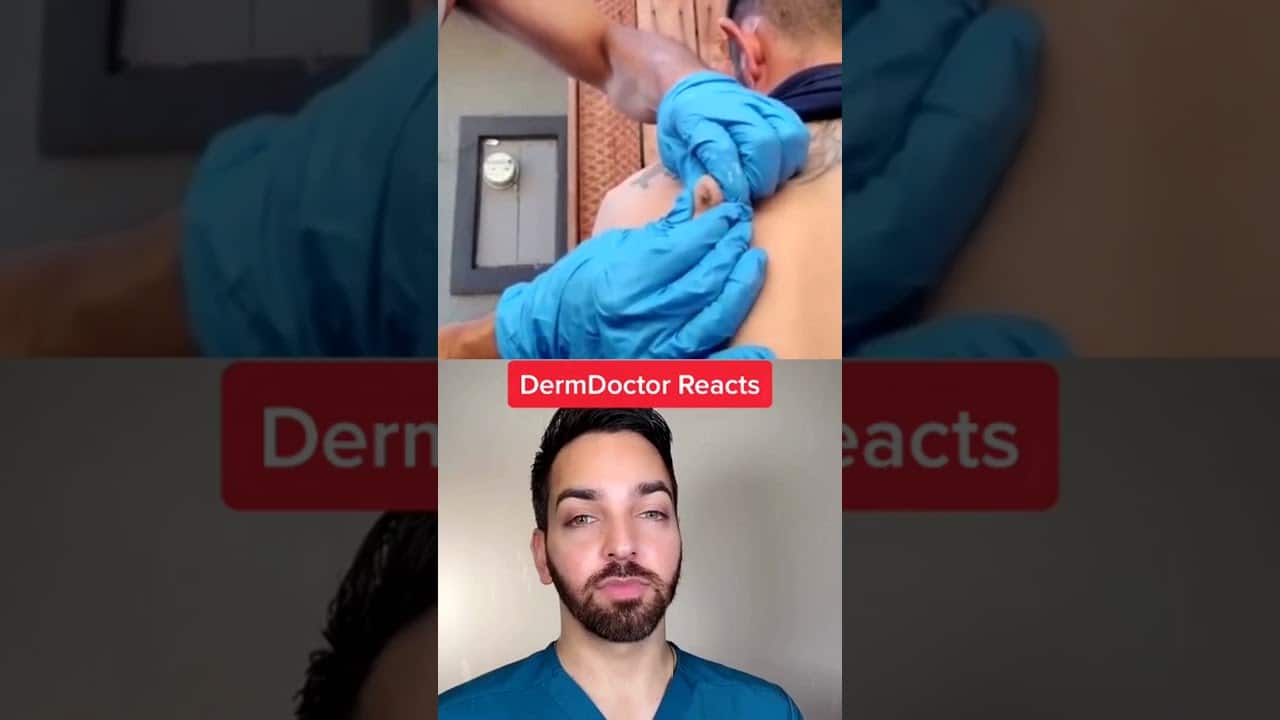 Blackheads 2021 newest dr pimple popping videos Ep 17