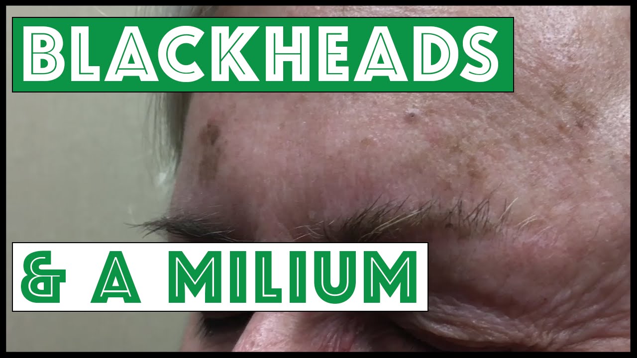 Blackheads and a Milium