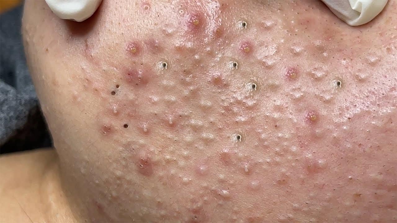 Blackheads and Acne Hide TOO MUCH on the patient's cheeks