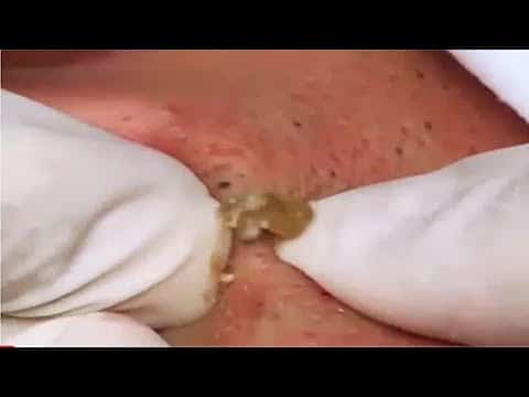 Blackheads And Acne Treatment, Acne Acne Popping, Skin Cleaning