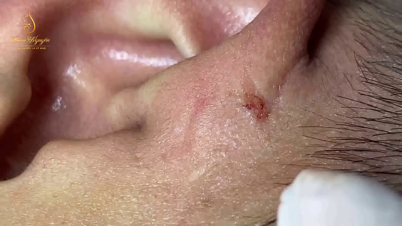 BLACKHEADS AND CYST on the ears (106) | Loan Nguyen