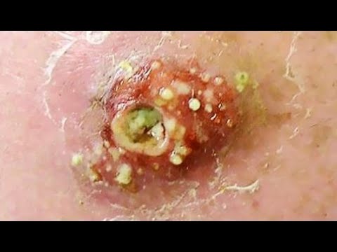 Blackheads And Pimple Popping Compilation 2017
