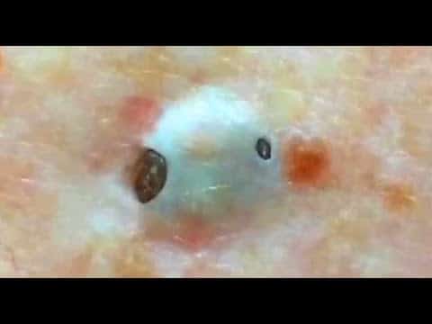 Blackheads and Pimple Popping Compilation (Educational)