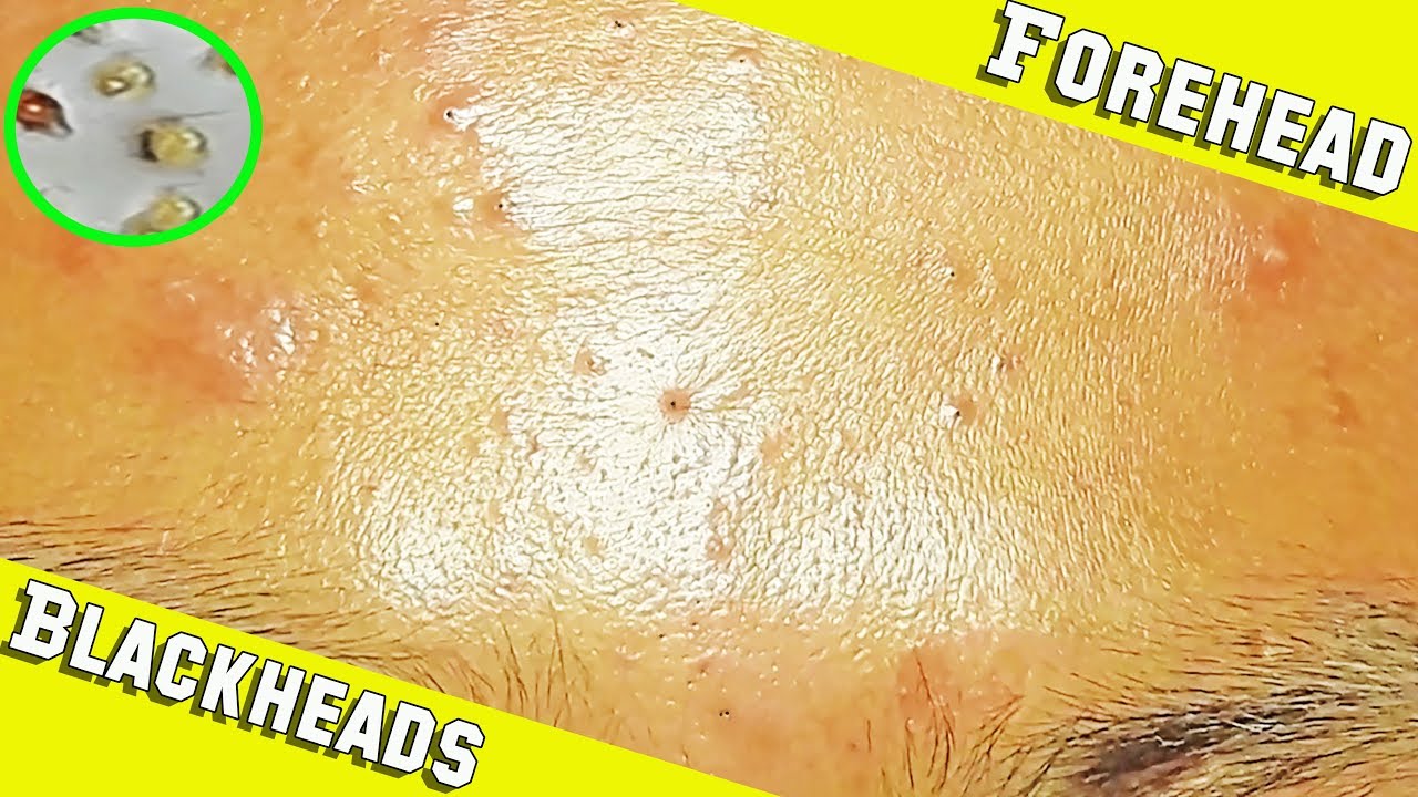 Blackheads & Cystic Acne Popping on Forehead