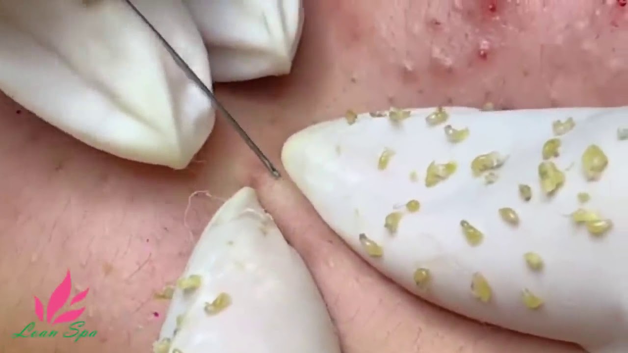 #blackheads# – #cystpop# – #pimples# #popper#