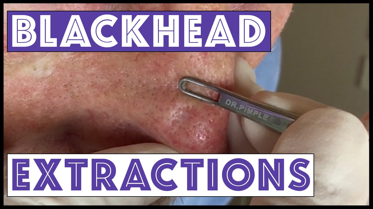Blackheads extracted after Mohs surgery