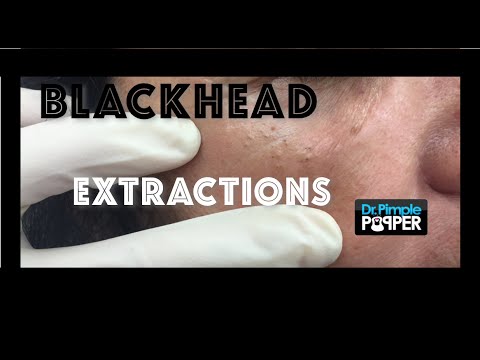 Blackheads extracted around the eyes: Favre Racouchot