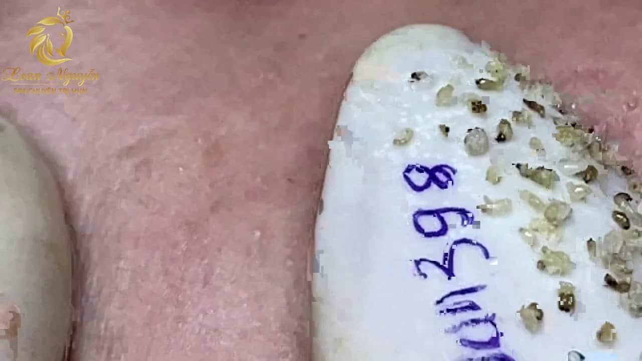 Blackheads extraction and pimple popping (398) | Loan Nguyen